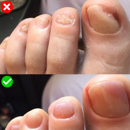 CuraNail™ | Herstelt Uw Nagels Terwijl U Slaapt | 1+1 gratis (42 pleisters)
