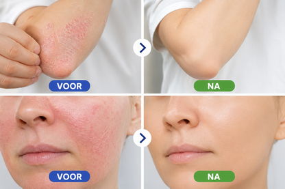 CalmSkin™ | Intensieve herstelbalsem bij droogheid, roodheid en schilfers
