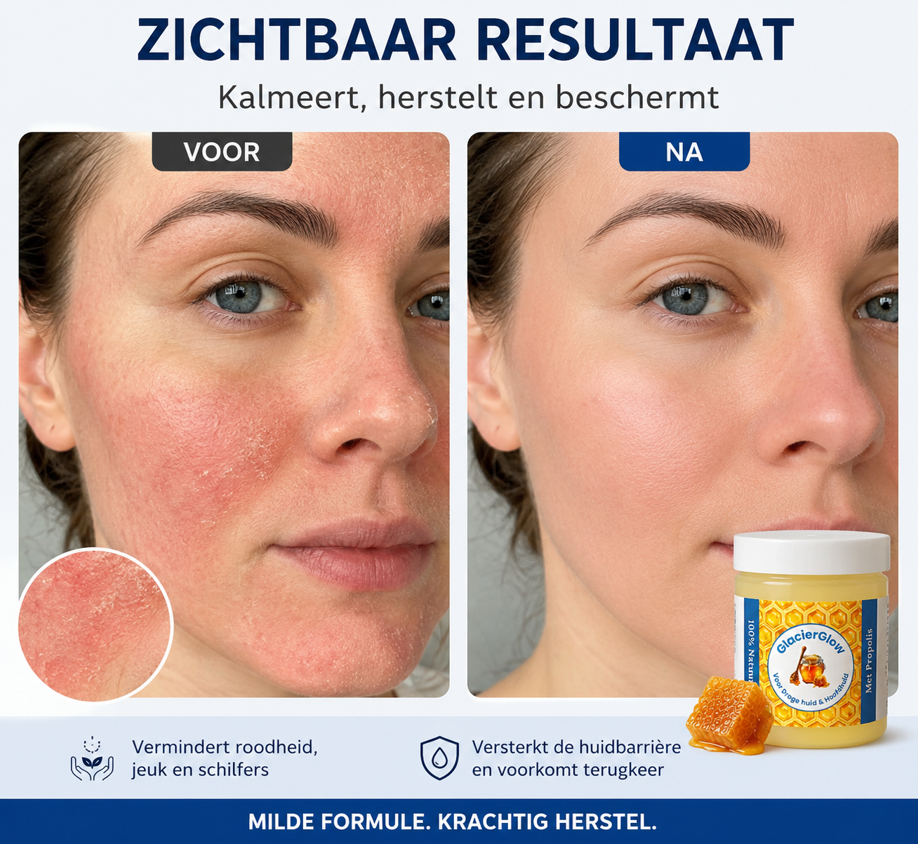 CalmSkin™ | Intensieve herstelbalsem bij droogheid, roodheid en schilfers