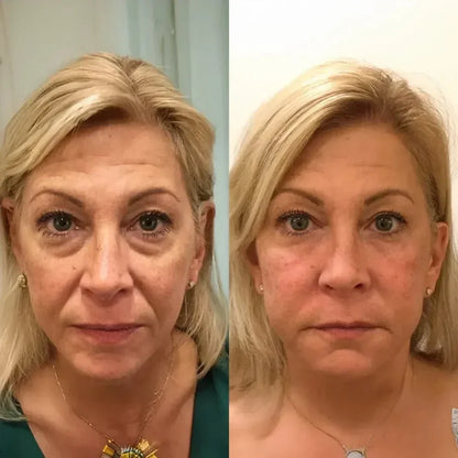 EyeLift™ | Laat wallen verdwijnen & strijk rimpeltjes glad in enkele minuten | 1+1 gratis