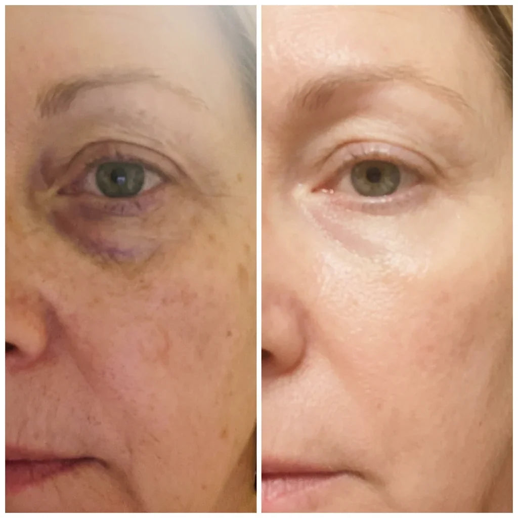 EyeLift™ | Laat wallen verdwijnen & strijk rimpeltjes glad in enkele minuten | 1+1 gratis